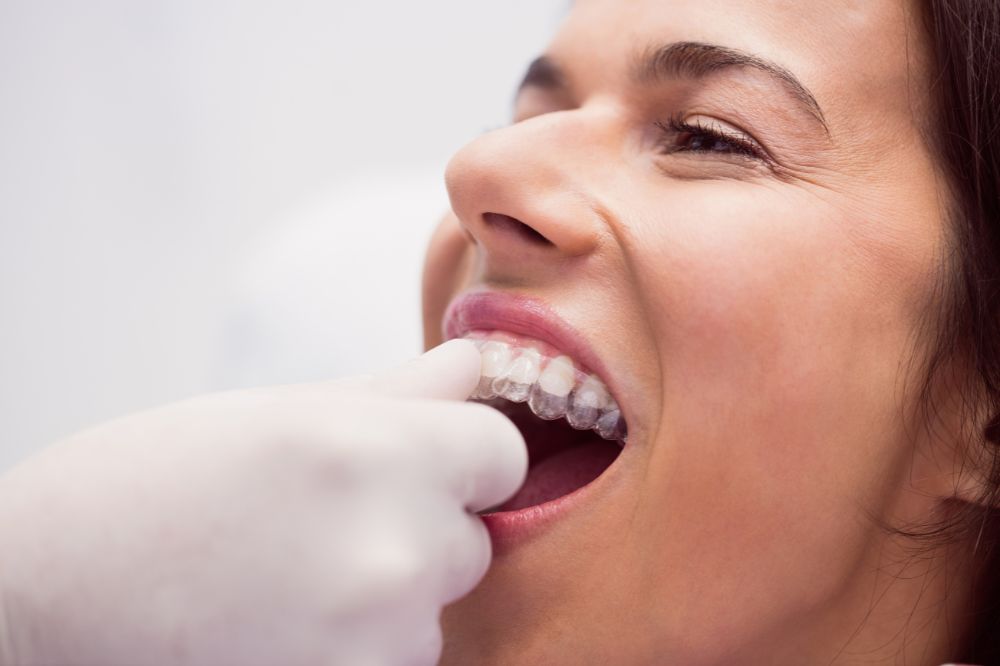 Invisalign in Coquitlam